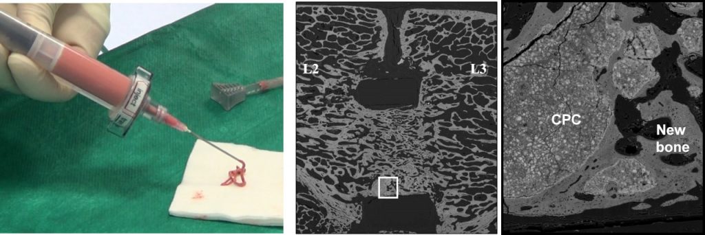 Calcium phosphate-based composites for bone therapies